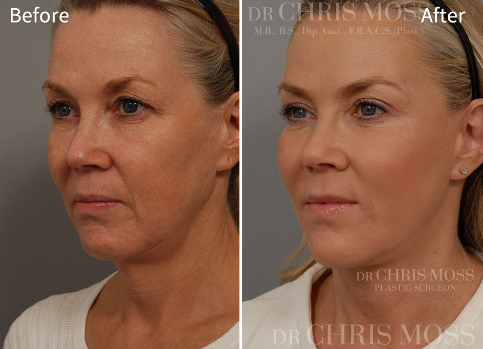 Facelift Melbourne Before and After (oblique) - Dr Chris Moss 2
