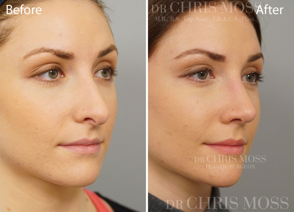 Rhinoplasty Melbourne Before and After (oblique) - Dr Chris Moss 5