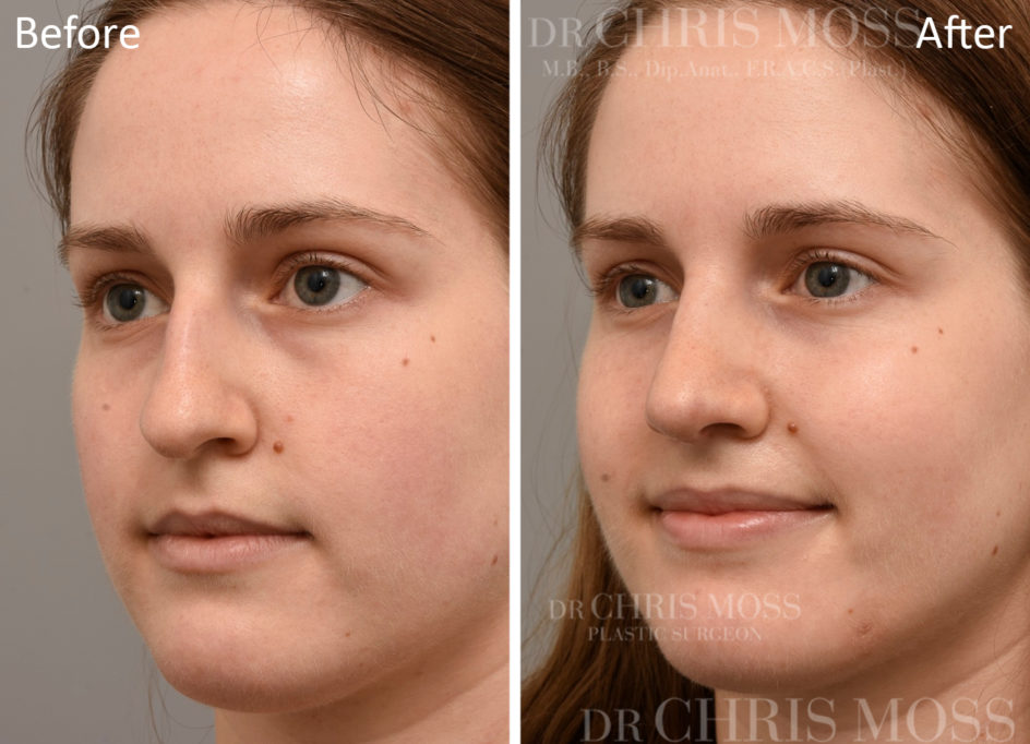 Rhinoplasty Melbourne Before and After (oblique) - Dr Chris Moss 6