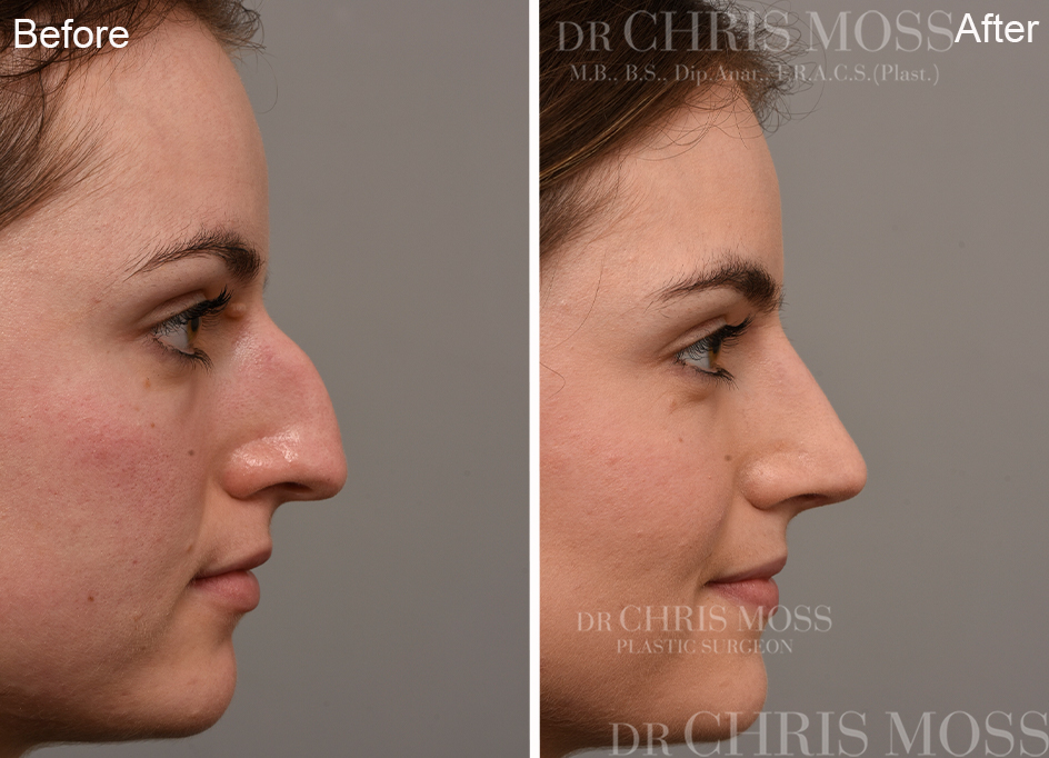 Rhinoplasty Before and After (profile) - Dr Chris Moss 4