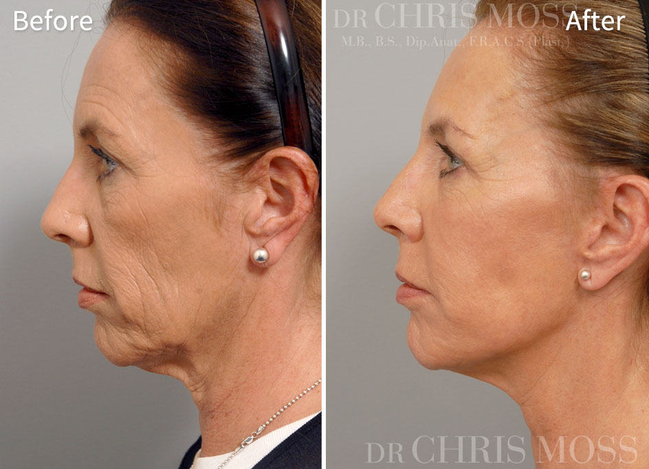 Before and after facelift 2A -oblique