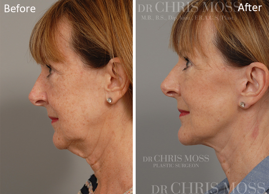 Facelift Melbourne Before and After (profile) - Dr Chris Moss 4