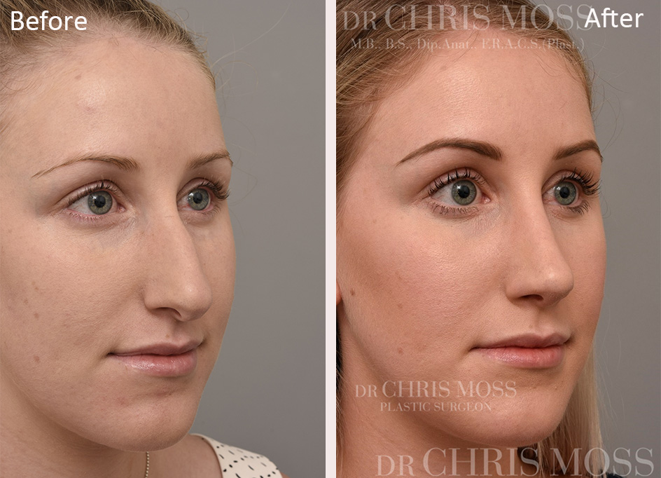 Rhinoplasty Before and After (oblique) - Dr Chris Moss 1