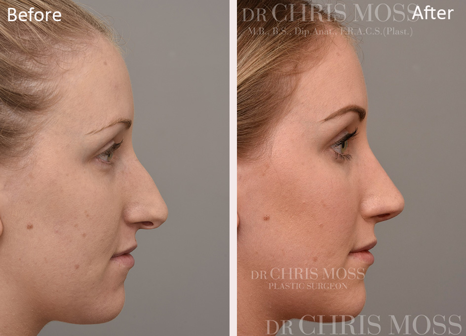 Rhinoplasty Before and After (profile) - Dr Chris Moss 1