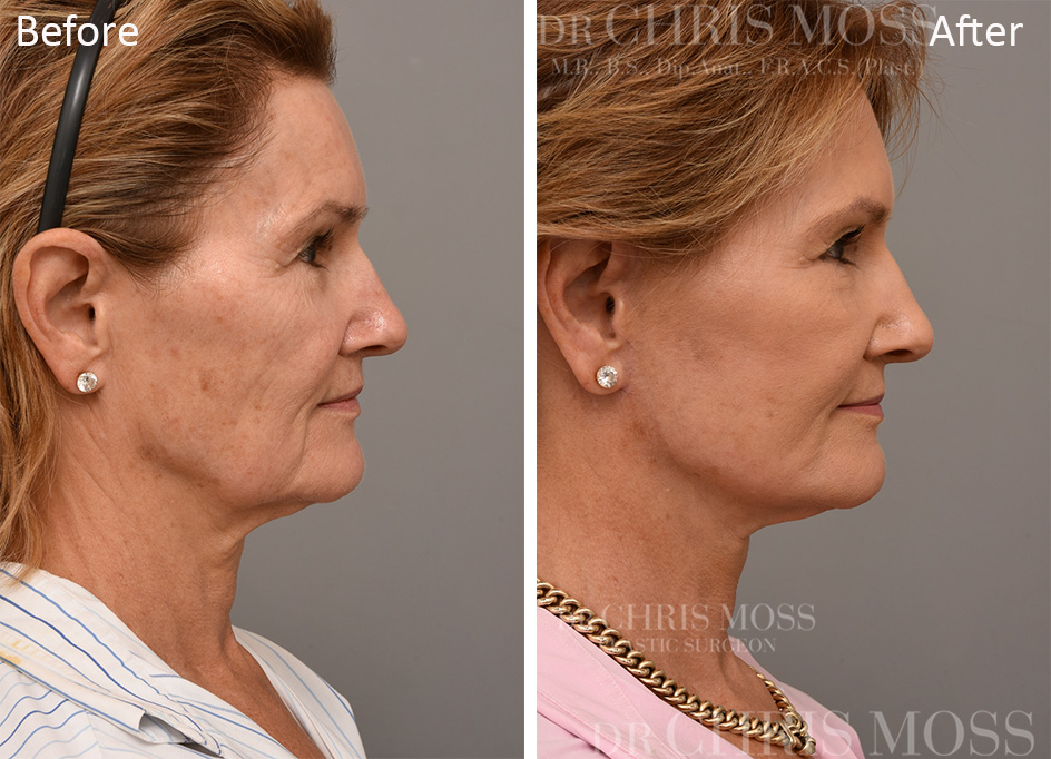 Facelift Melbourne Before and After (profile) - Dr Chris Moss 5
