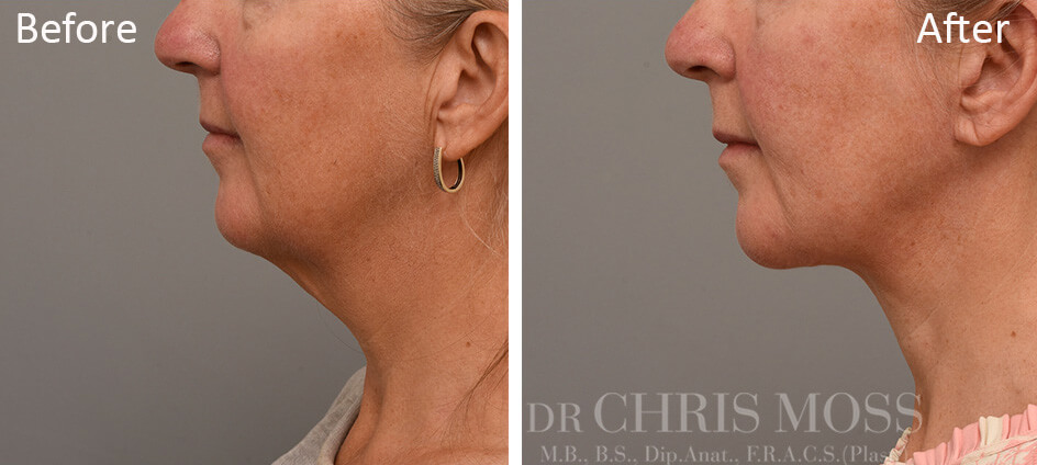 Extended Lateral (side of) Neck Lift & Submental (front of) Neck Lift with Platysmaplasty, Liposculpture to jowls.