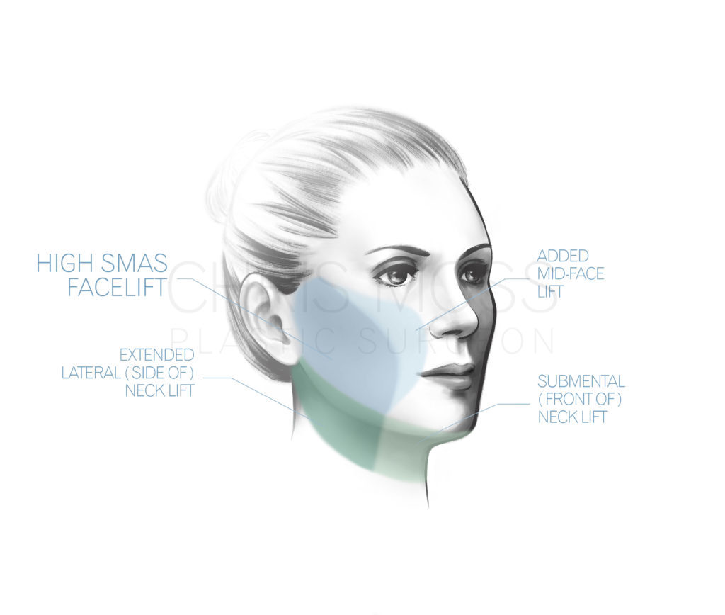 Facelift Surgery, Dr Chris Moss, Facelift Rejuvenation