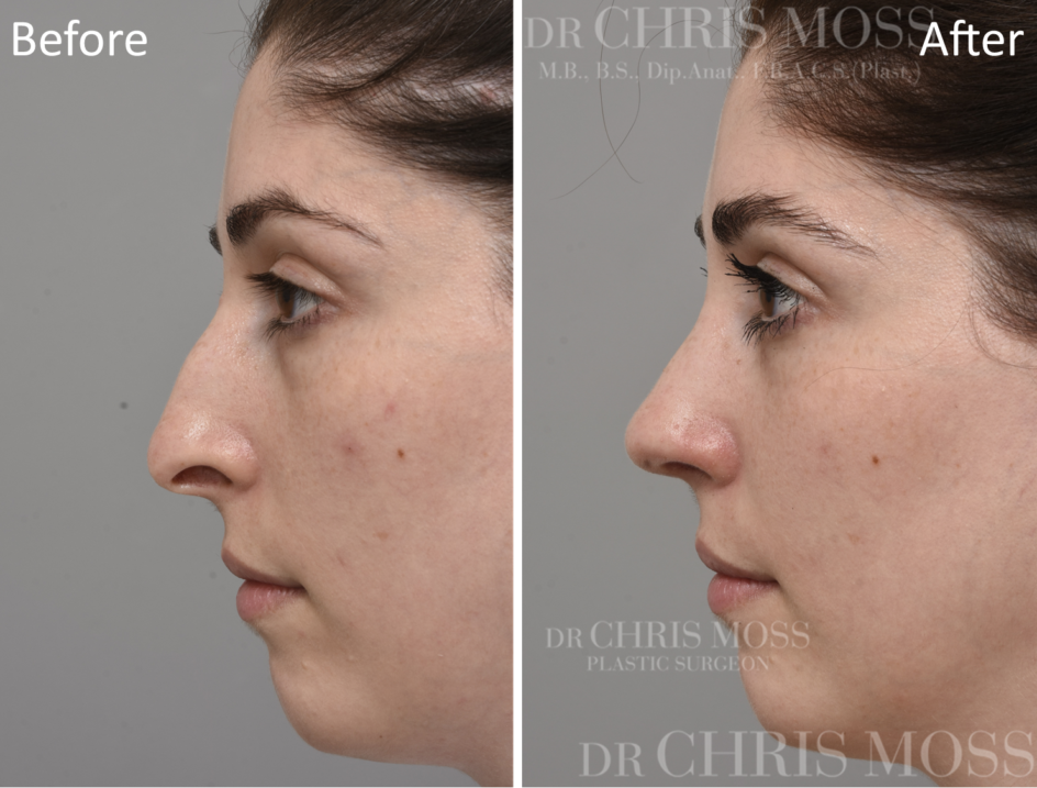 Rhinoplasty Before and After (oblique) - Dr Chris Moss 3