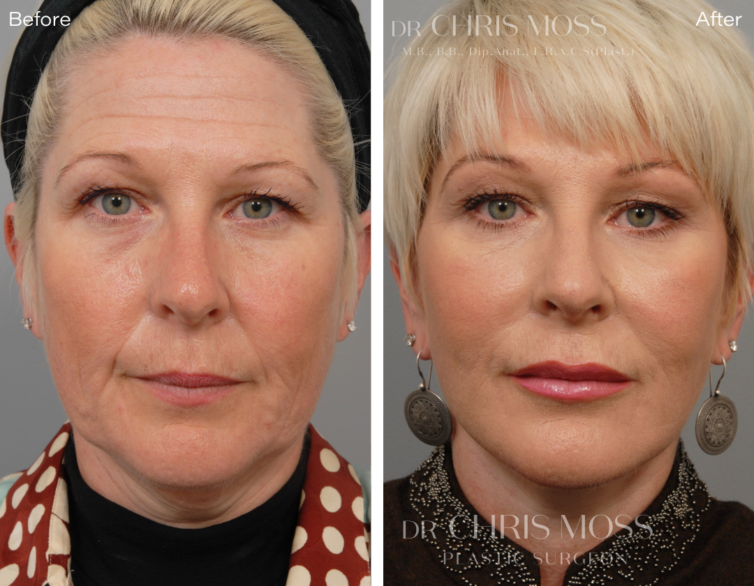 Facelift & Neck Lift Results - Before and After