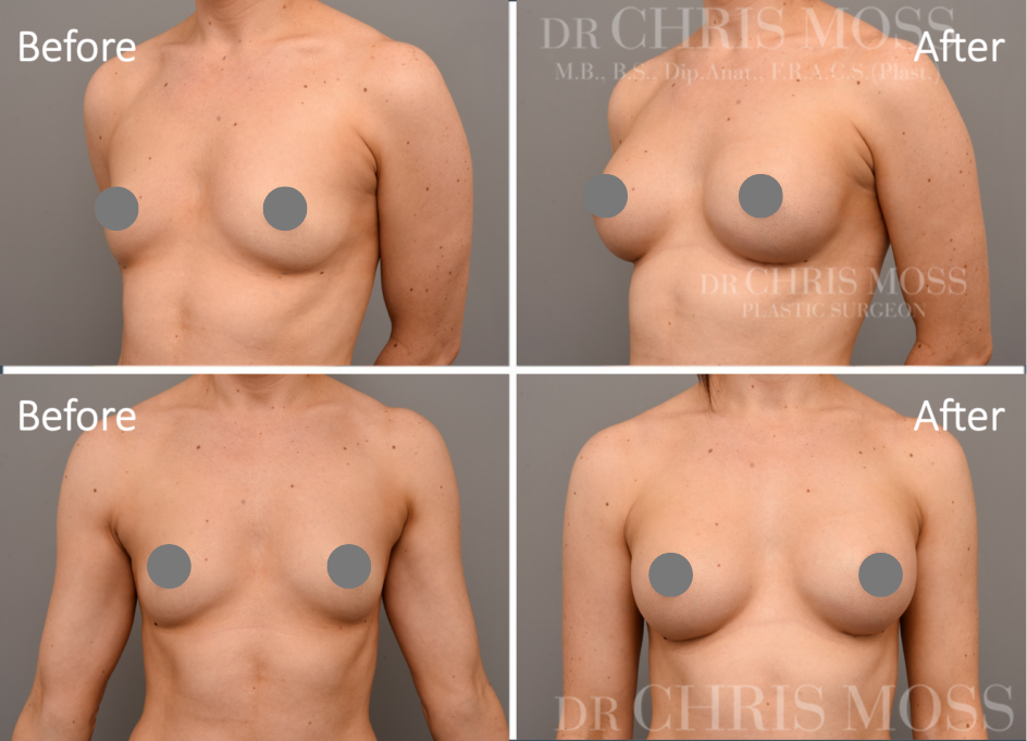 Breast Augmentation