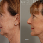 Facelift, Before and After results, Dr Chris Moss