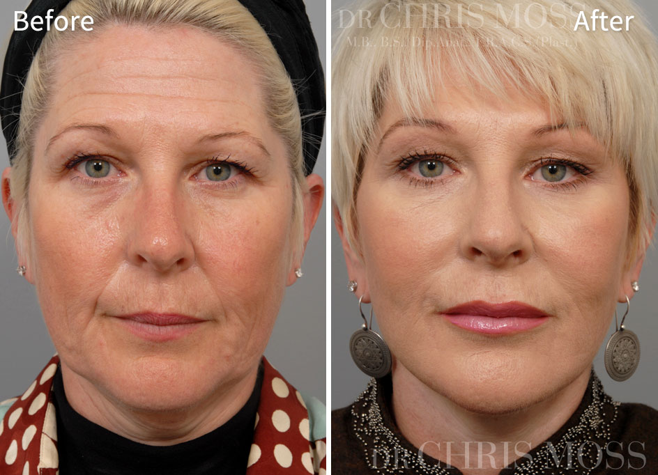 Facelift Melbourne Before and After (front) - Dr Chris Moss 1