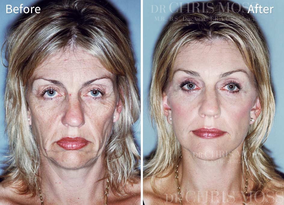 Facelift Melbourne Before and After (front) - Dr Chris Moss 3