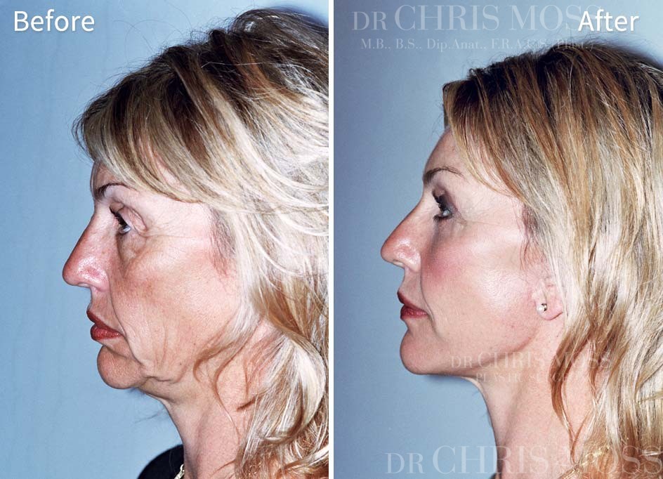Facelift Melbourne Before and After (profile) - Dr Chris Moss 3