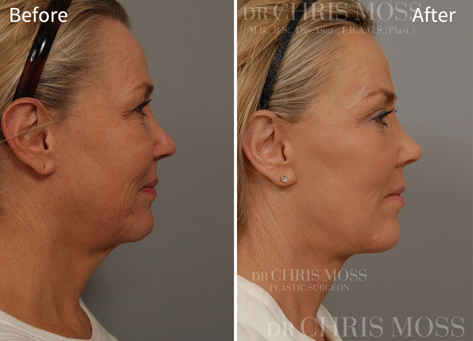 Facelift Melbourne Before and After (profile) - Dr Chris Moss 2