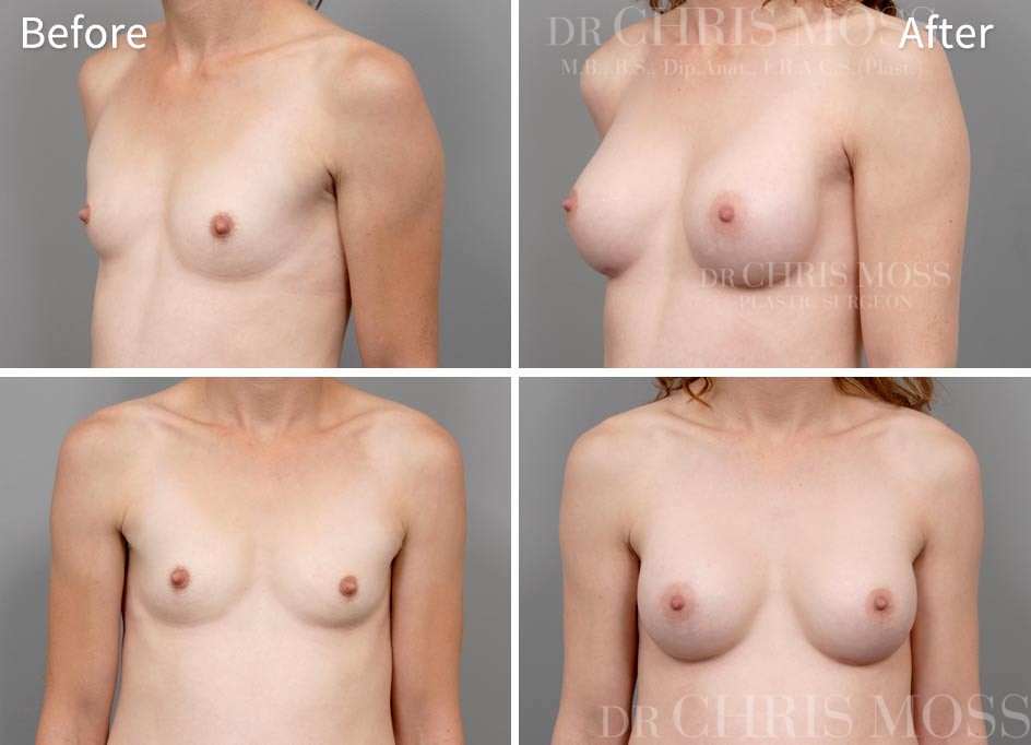 Breast_augmentation032
