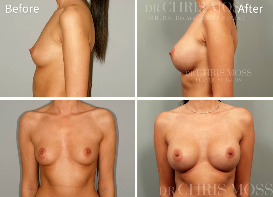 Breast Augmentation Before and After 5