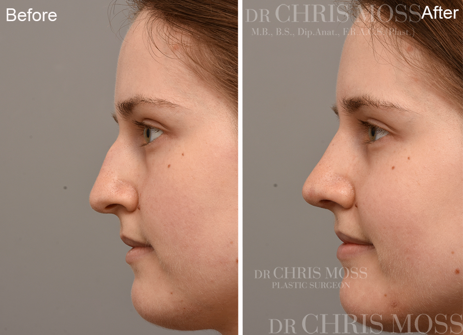 Rhinoplasty Before and After (profile) - Dr Chris Moss 6