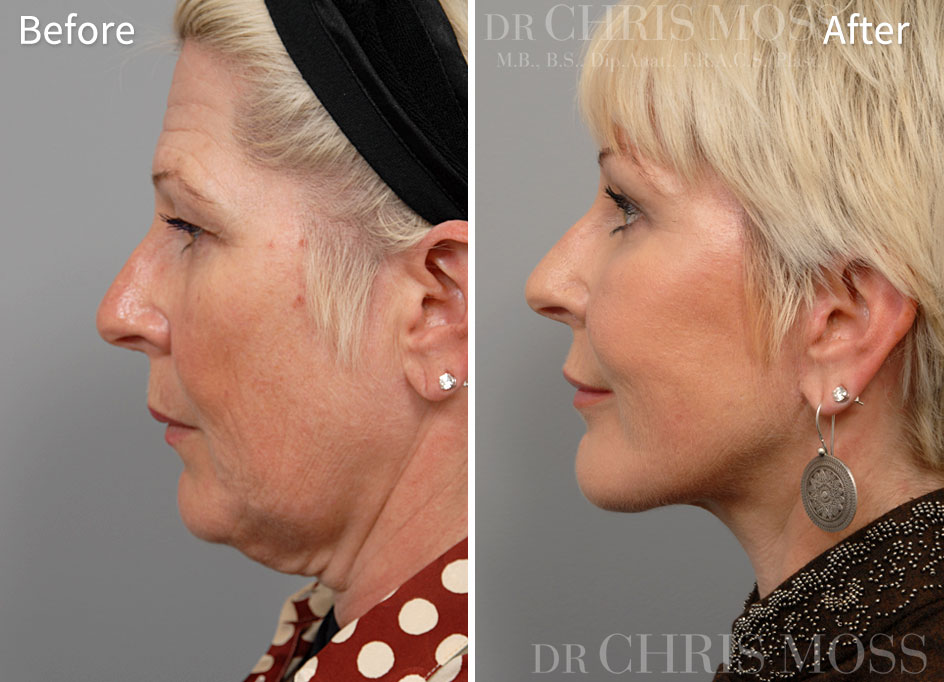 Facelift Melbourne Before and After (profile) - Dr Chris Moss 1