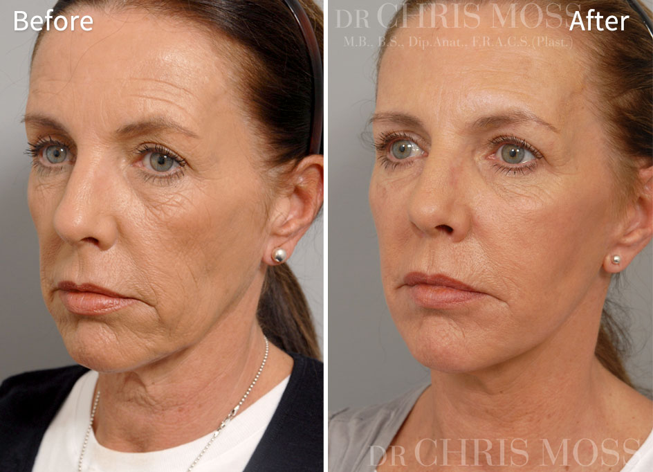 Before and after facelift 2 - oblique