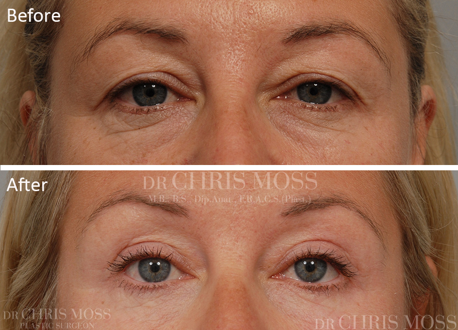 Eyelid Surgery (Blepharoplasty) Melbourne Before and After - Dr. Chris Moss 5A