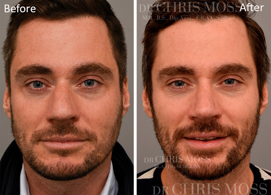 Rhinoplasty Before and After (front) - Dr Chris Moss 2