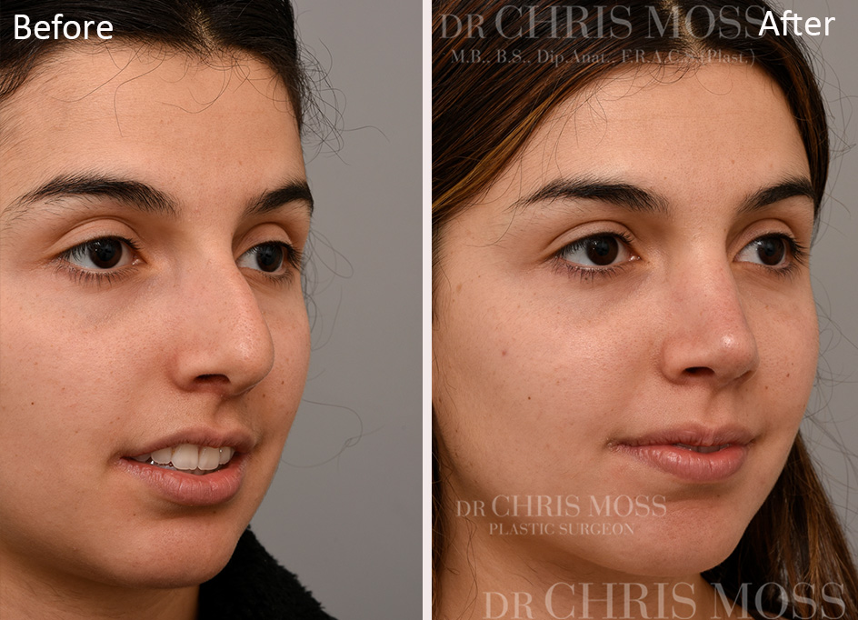 Rhinoplasty Before and After (oblique) - Dr Chris Moss 7