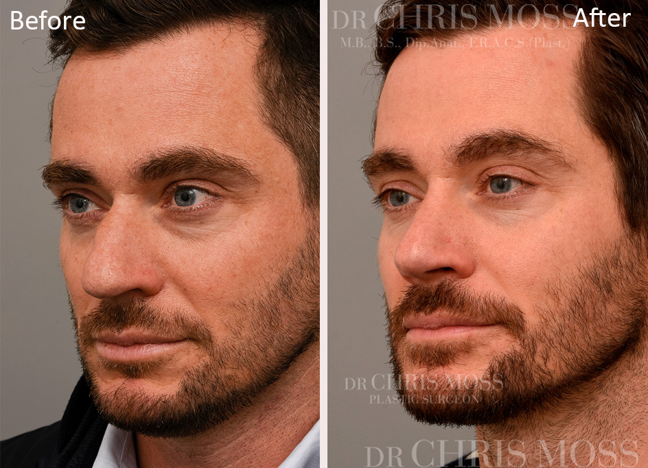 Rhinoplasty Before and After (oblique) - Dr Chris Moss 2
