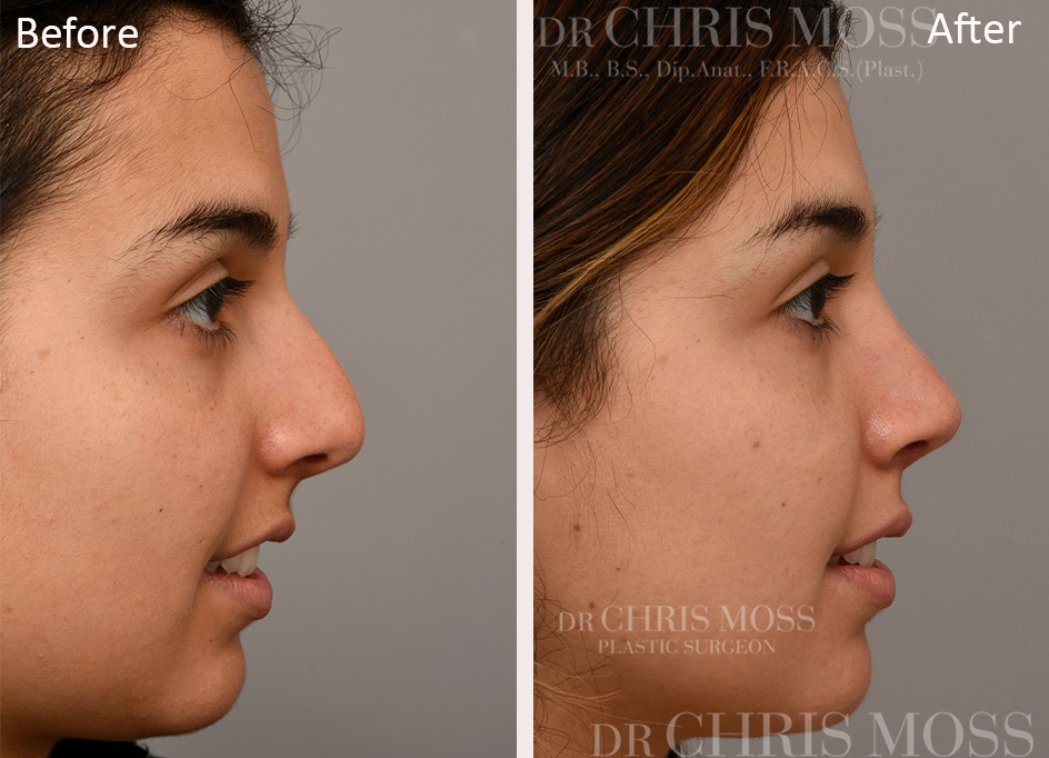 Rhinoplasty Before and After (profile) - Dr Chris Moss 7