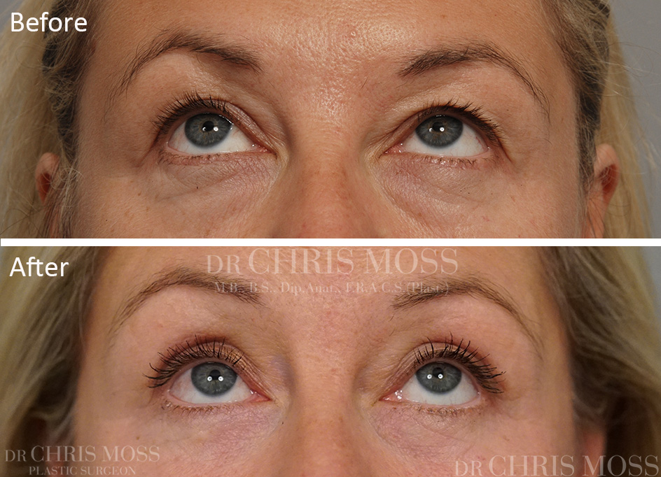 Eyelid Surgery (Blepharoplasty) Melbourne Before and After - Dr. Chris Moss 4