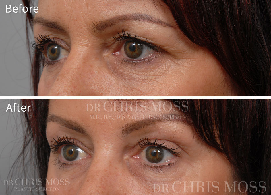 Eyelid Surgery (Blepharoplasty) Melbourne Before and After - Dr. Chris Moss 2