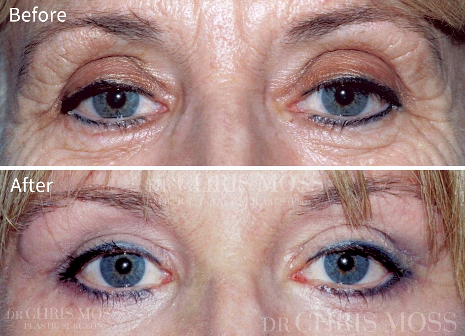 Blepharoplasty0321