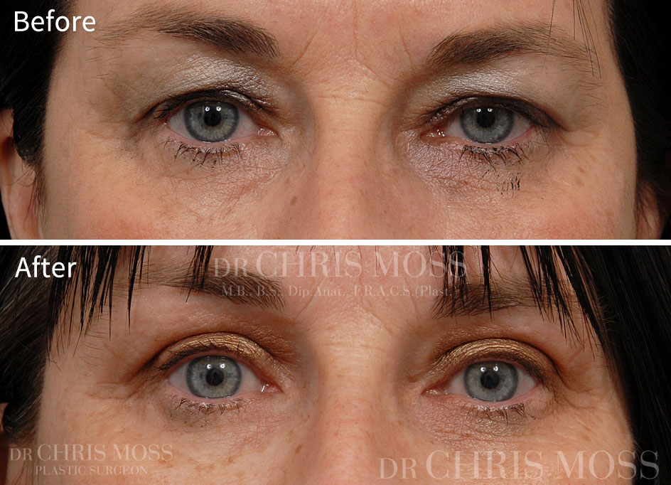 Eyelid Surgery (Blepharoplasty) Melbourne Before and After (front) - Dr. Chris Moss 3
