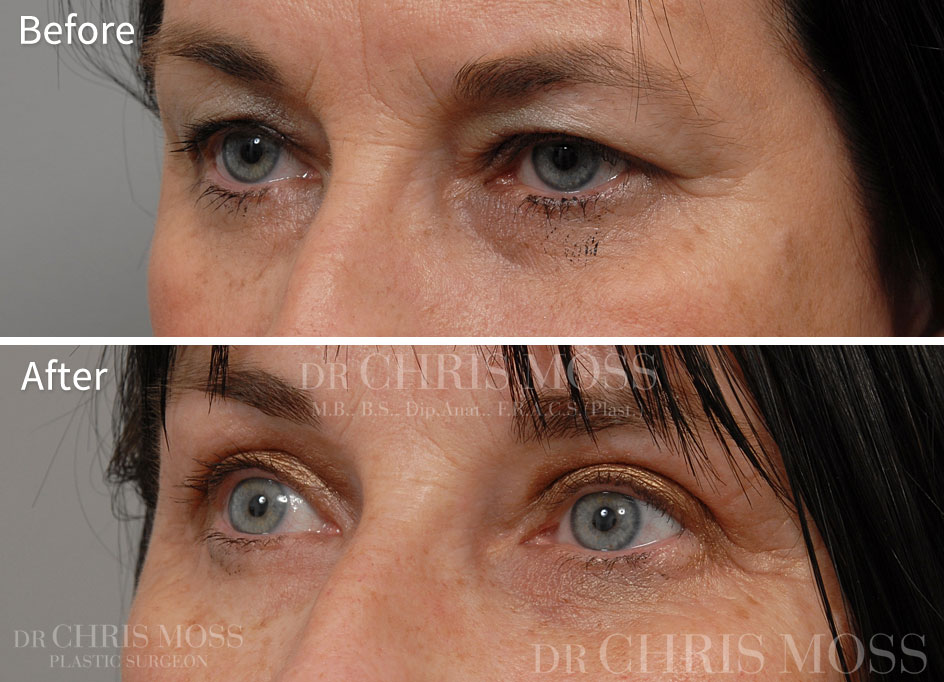 Eyelid Surgery (Blepharoplasty) Melbourne Before and After (oblique) - Dr. Chris Moss 3