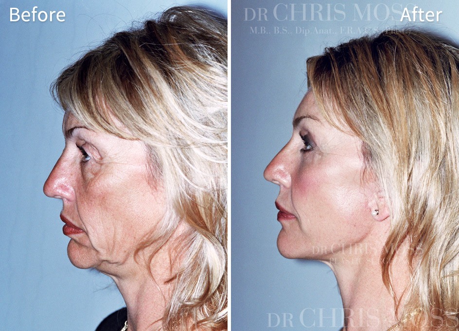 Facelift & Neck Lift Results - Before and After