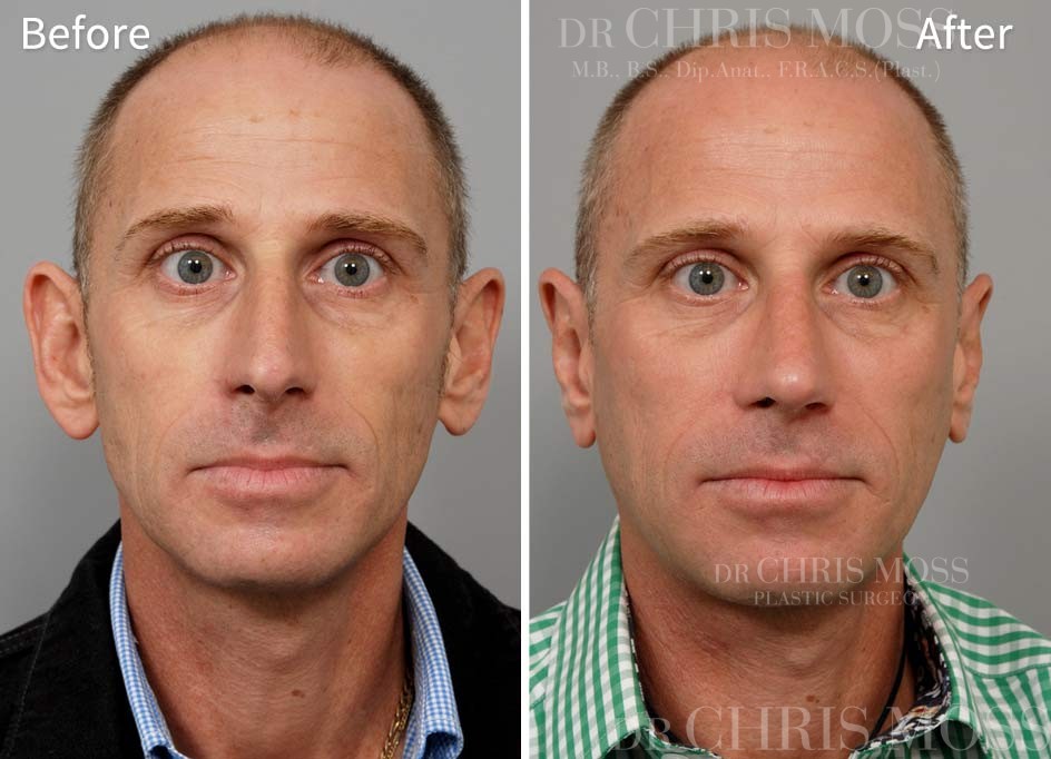 Otoplasty Before and After (front) - Dr Chris Moss 1