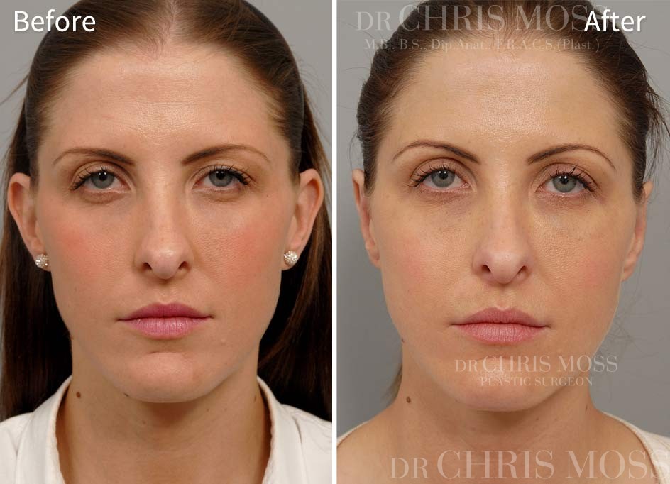 Otoplasty Before and After (front) - Dr Chris Moss 2