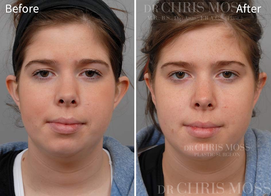 Otoplasty Before and After (front) - Dr Chris Moss 3