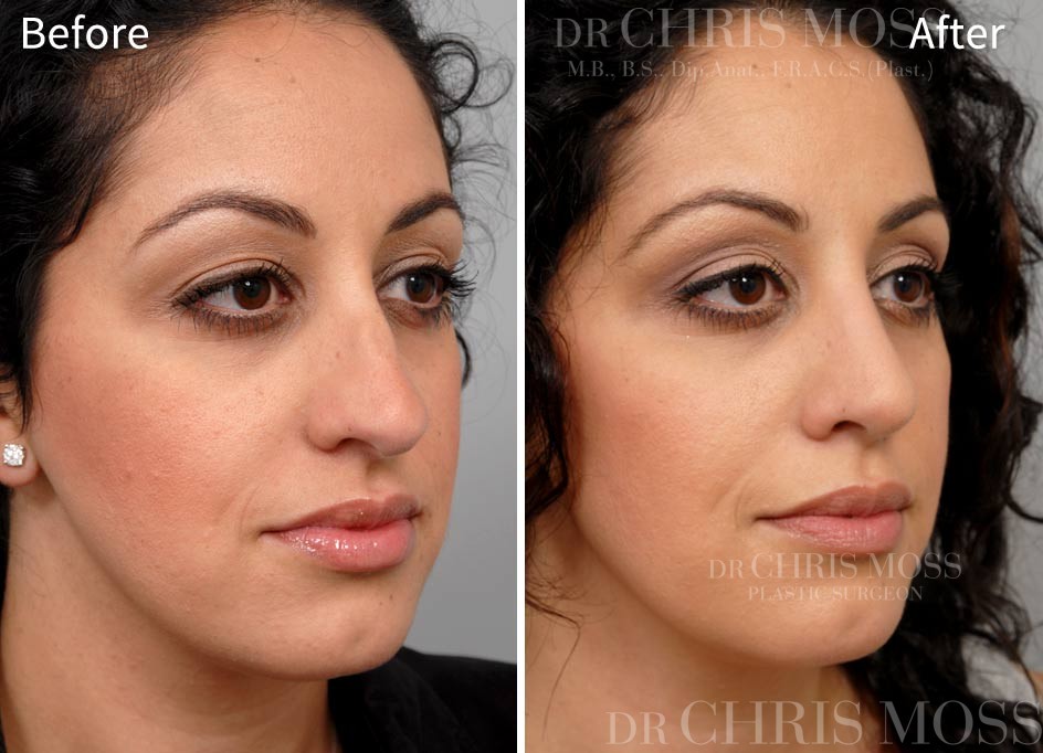 Rhinoplasty Before and After (oblique) - Dr Chris Moss 7