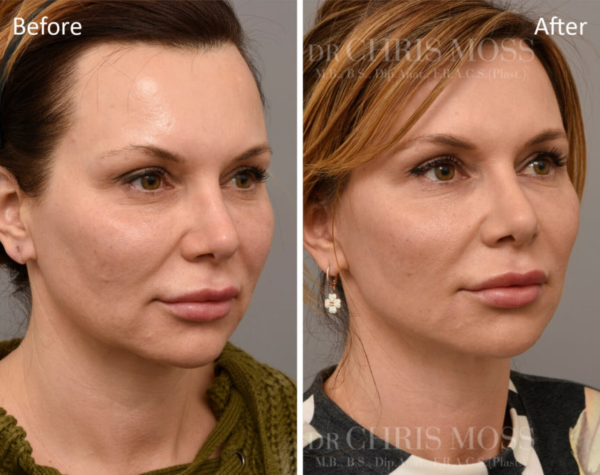 Short Incision Facelift Melbourne Before and After (oblique) - Dr Chris Moss 8