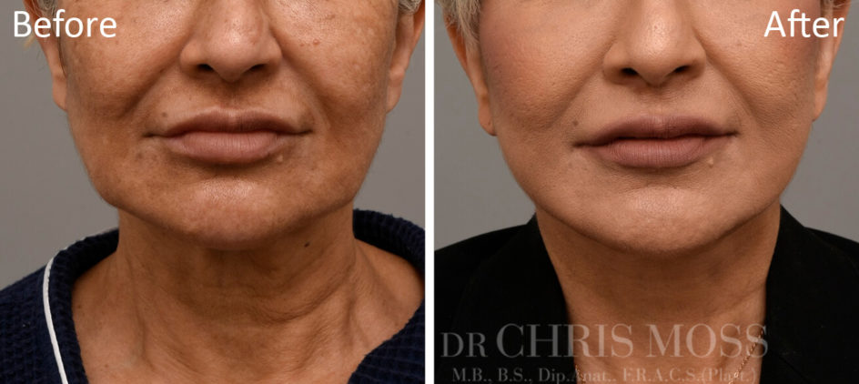 Facelift Melbourne Before and After (front) - Dr Chris Moss 6