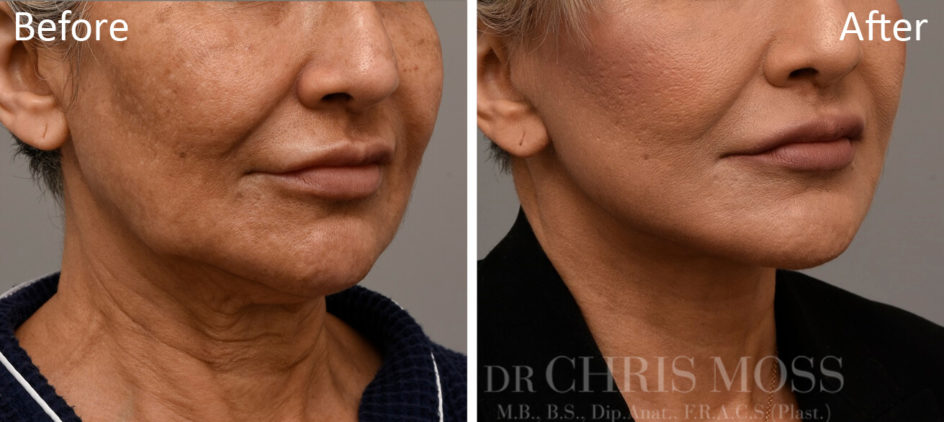 Facelift Melbourne Before and After (oblique) - Dr Chris Moss 6