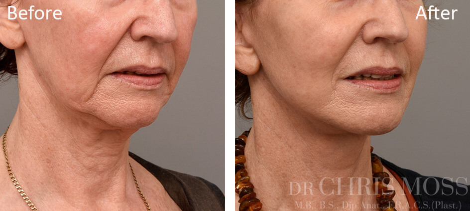 Facelift Melbourne Before and After (oblique) - Dr Chris Moss 7