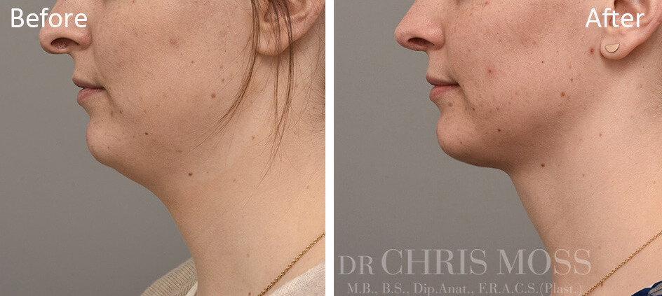 Neck Lift Melbourne, Before and After (profile) - Dr Chris Moss 3