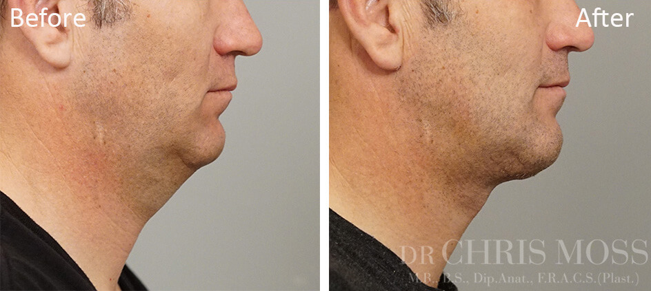 Neck Lift Melbourne, Before and After (profile) - Dr Chris Moss 4