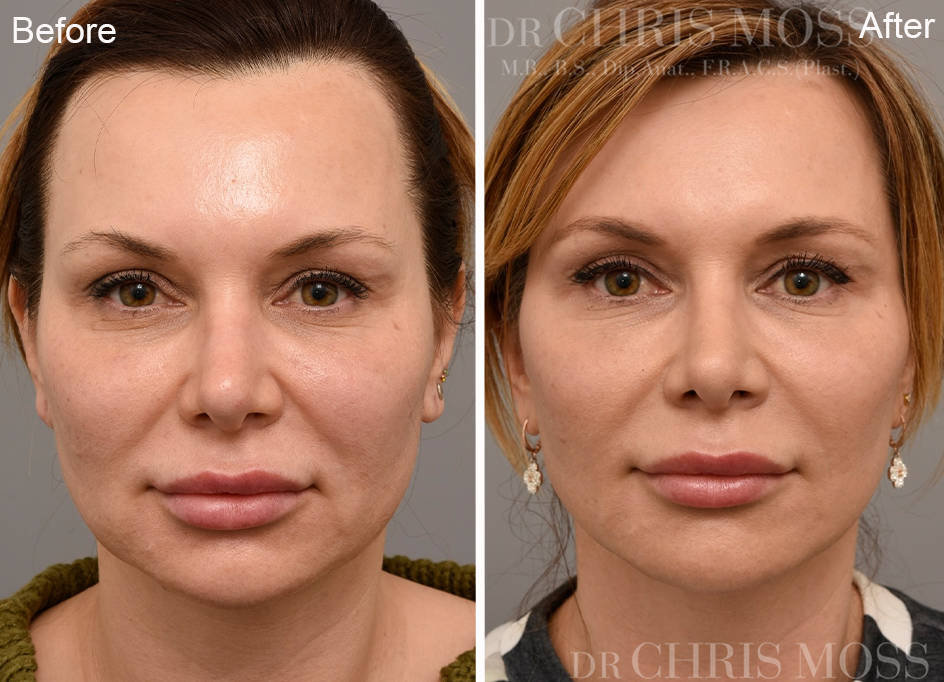 Mid Face Lift 1 - Before and After - Oblique View