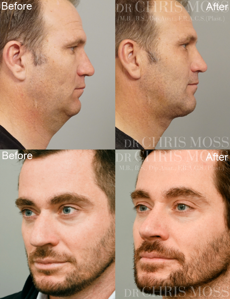 Plastic & Cosmetic Surgery for Men in Melbourne, Australia