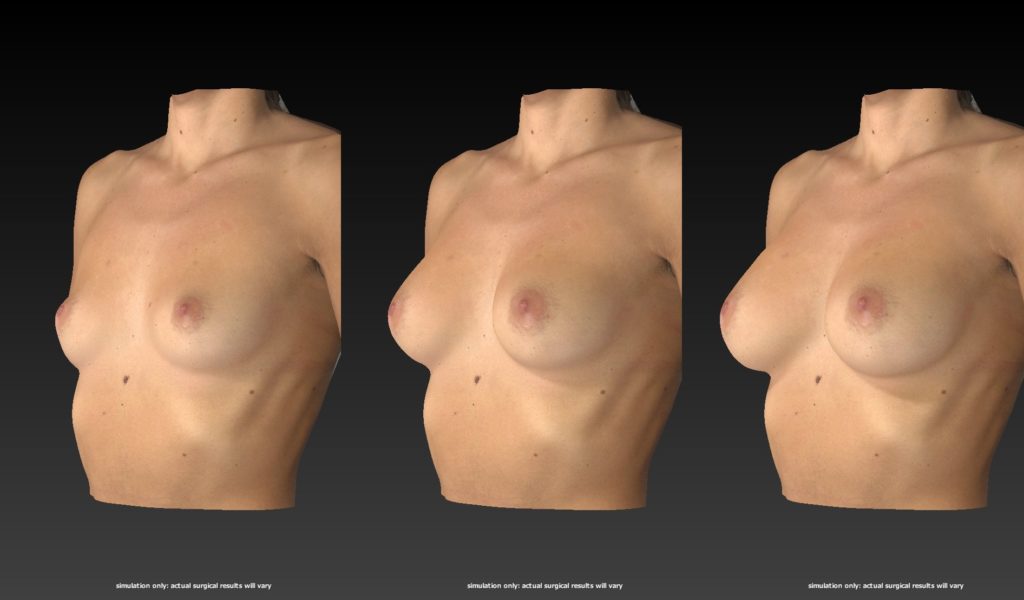 Breast Augmentation & Enhancement Procedures