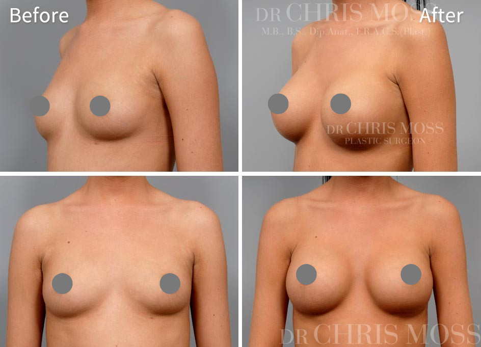 Breast Augmentation