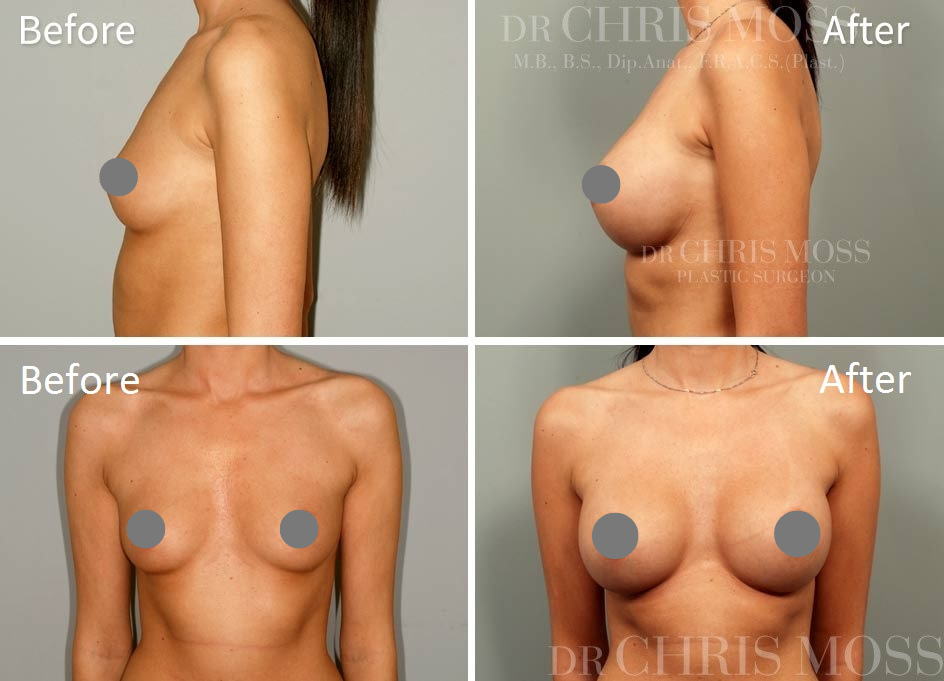 Breast Augmentation